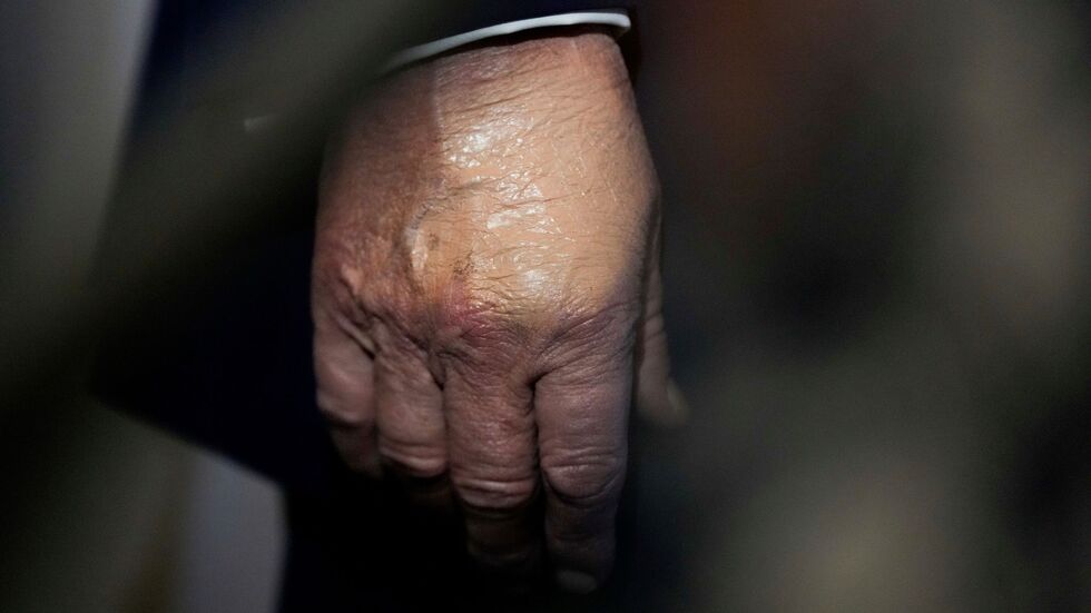 Nachdem der Bluterguss am Handrücken für Aufsehen sorgte, wurde er häufig bei Auftritten zugeschminkt. (Archivbild)